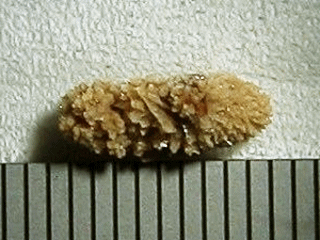 膀胱内に見られる結石