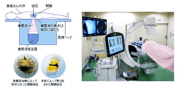 切らないで治す！ESWL手術など最先端の治療法