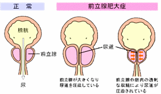 前立腺肥大の画像